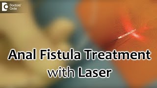 Anal Fistula Treatment with Laser Painless and best recovery for fistula  Dr Rajasekhar M R [upl. by Limaj914]