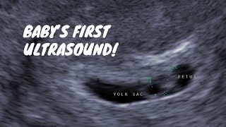 Babys First Ultrasound 6 Weeks Pregnant [upl. by Renelle]