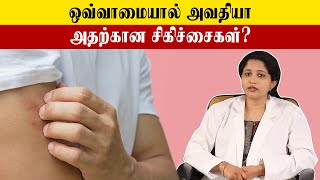 Easily to Cure Urticaria  உடலில் ஏற்படும் ஒவ்வாமை தடுப்பது எப்படி  Samayam Tamil [upl. by Haissi453]