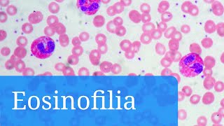 Eosinofilia qué indican los eosinófilos altos y cuál es el tratamiento [upl. by Aryam]