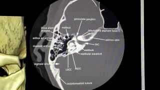 Facial Nerve Segments [upl. by Eilasor]