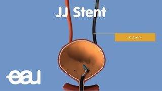 Behandlung von Nieren und Harnleitersteinen JJstent [upl. by Samanthia]