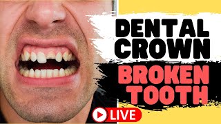 Tooth Crown Procedure  Front Tooth Crowns for Broken Teeth LIVE [upl. by Ylrehc658]