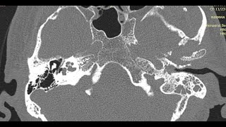 How to Read HRCT Temporal Bone  All Basics in Detail [upl. by Gregg899]