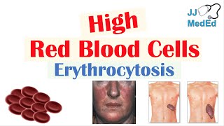 High Red Blood Cells Erythrocytosis  Causes Signs and Symptoms and Treatment [upl. by Eisen]