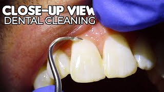 Dental Cleaning  CloseUp View ASMR [upl. by Rockefeller643]