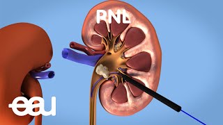 Behandlung von Nieren und Harnleitersteinen PNL [upl. by Stranger]