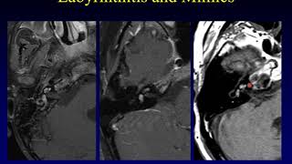 Temporal Bone Pathology 6 Hearing Loss Part 1 [upl. by Ruddy]