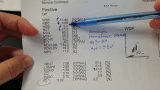 Hematology How to interpret automated Complete Blood Count CBC results [upl. by Edlun534]