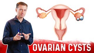 Ovarian Cysts Causes Symptoms amp Natural Treatment – DrBerg [upl. by Ardnaeed]