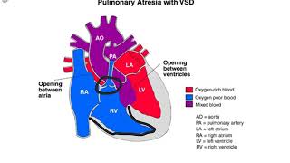 Pulmonary Atresia [upl. by Kenison]