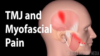 TMJ and Myofascial Pain Syndrome Animation [upl. by Noirrad483]