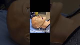 Laryngospasm notch  Larsons point  Stridor ✓ Jaw thrust maneuver ✓ shortvideo [upl. by Ailuy395]