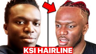 Hair Surgeon Reacts to KSI Hairline [upl. by Dekeles]