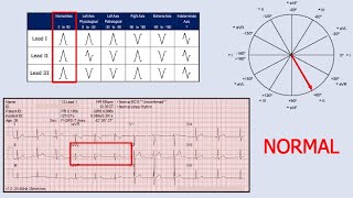 Cardiac Axis Determination [upl. by Ellirpa111]