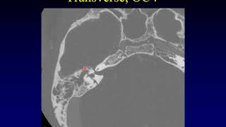 Temporal Bone Pathology 10 Trauma [upl. by Paz776]