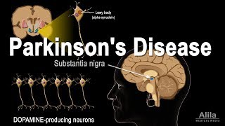 Parkinsons Disease Animation [upl. by Cocke]