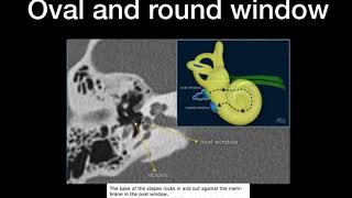 CT temporal bone Basic anatomy Simplified [upl. by Sandon111]