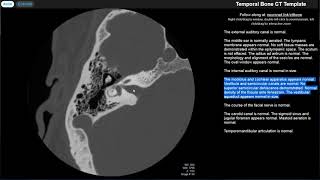 Radiology Walkthroughs  CT Temporal Bone Anatomy [upl. by Anier93]