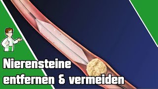 Nierensteine entfernen und vermeiden  SO geht es 👨‍⚕️ [upl. by Menken]