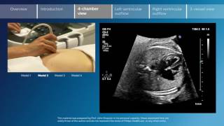 Key screening views of the fetal heart  Part 3  4chamber view [upl. by Ahsemo816]