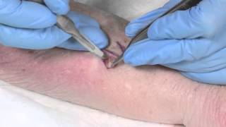 How to Suture  part 4 the Z plasty [upl. by Radec]