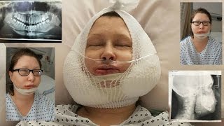 Jaw Surgery Day Vlog  Recovery day 130 [upl. by Nnaeirual]