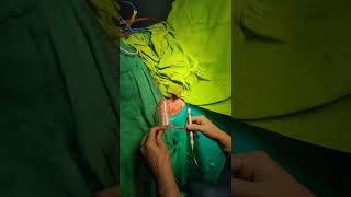 Advanced LASER Haemorrhoids Piles Treatment by Dr Hina Khan [upl. by Petuu]