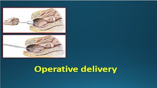 OPERATIVE DELIVERY  Instrumental deliveries Vacuum amp Forceps [upl. by Igor799]