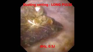 Laser Lithotripsy  Laser Kidney Stones  Setting Demonstration  Sydney NSW [upl. by Adebayo244]