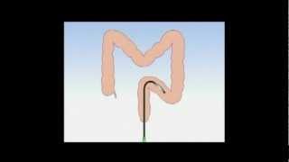 Gastroscopy  OGD  How to prepare [upl. by Ximena]