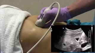 How I do it Ultrasound of the Abdomen [upl. by Severn962]