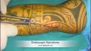 Endoscopic forearm fasciotomy [upl. by Latsyrhk858]