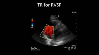 Principles of Doppler Ultrasound [upl. by Atiuqcir921]