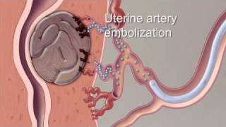 All about Uterine Inversion  Dr Teena S Thomas [upl. by Gordy114]