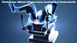 Laser Hemorrhoidoplasty LHP  IBI Healthcare Institute [upl. by Angeli]