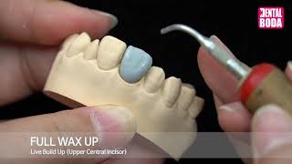 Full wax up Upper Central Incisor [upl. by Amadeo]