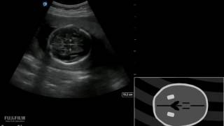 How To Pregnancy BPD HC AC and FL Measurements 3D Video [upl. by Sweyn692]