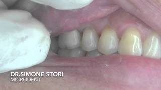 Dente affetto da Parodontite Severa Curato con Laser [upl. by Bastien]