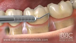 Periodontal disease causes and treatment [upl. by Anihsak202]