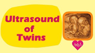 Sonography of Twins [upl. by Socram802]