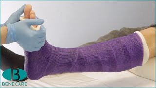 How to Apply a Below Knee Conventional Cast [upl. by Annaet]