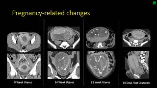 Gynecologic Radiology Anatomy [upl. by Aiyotal496]