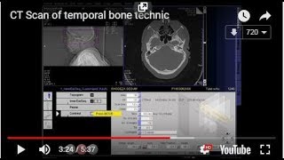 CT Scan of temporal bone technic [upl. by Falk]