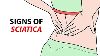 Signs of Sciatica [upl. by Llerihs]