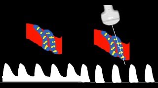 Umbilical Artery Doppler interpretation [upl. by Laitselec]