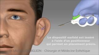 TC 5  Anatomie de loreille externe et de loreille moyenne Anatomy of the outer and middle ear [upl. by Mace]