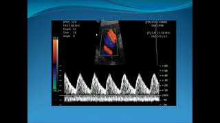 Obstetric Doppler Part 1 [upl. by Alpert]