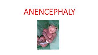 ANENCEPHALY [upl. by Aisetal]